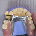 Understanding Impression and Fabrication in Dental Crowns