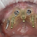 Understanding Implant Placement Surgery