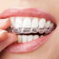 All You Need to Know About Invisalign
