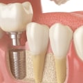 The Importance of Preserving Your Jawbone for Dental Implants