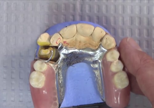 Understanding Impression and Fabrication in Dental Crowns