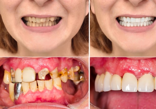 Correcting Dental Imperfections: Your Guide to a Perfect Smile