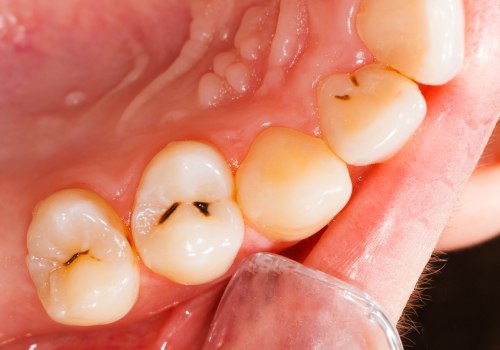 Restoring Damaged or Decayed Teeth: Everything You Need to Know