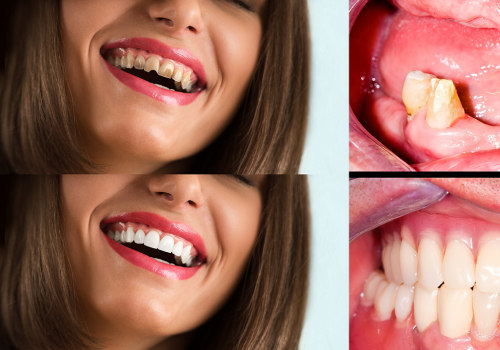 Dental Crowns: What You Need to Know for a Full Mouth Reconstruction