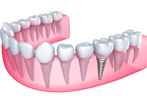 Healing and Restoration: The Key to Successful Dental Implants