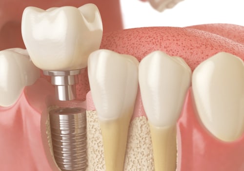 The Importance of Preserving Your Jawbone for Dental Implants